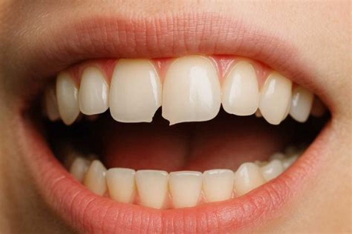 
What Happened To Boris Johnson’s Teeth? Story Of Fed Up With The Back Tooth 